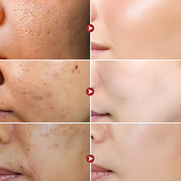 BotoxFace PREMIUM - Retire Imperfeições Faciais | COMPRE 1 LEVE 2 + Frete GRÁTIS