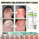 Efero Nails - Removedor de Fungos/Micoses + Fortalecimento das Unhas |COMPRE 2 LEVE 3| Frete Grátis