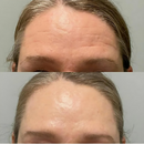 BotoxFace PREMIUM - Retire Imperfeições Faciais | COMPRE 1 LEVE 2 + Frete GRÁTIS