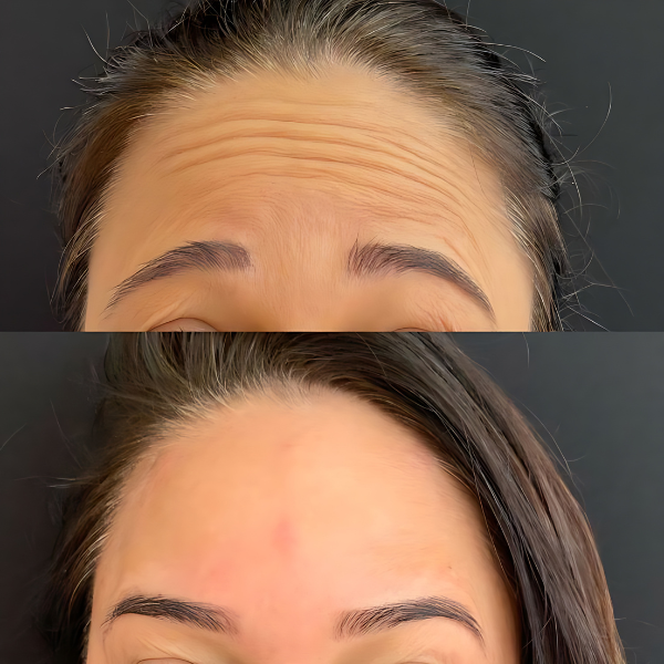 BotoxFace PREMIUM - Retire Imperfeições Faciais |COMPRE 1 LEVE 2| Frete Grátis