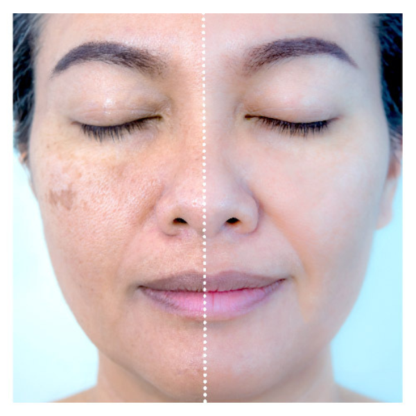 BotoxFace PREMIUM - Retire Imperfeições Faciais | COMPRE 1 LEVE 2 + Frete GRÁTIS