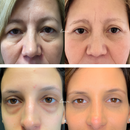 COMPRE 1 LEVE 2 - VisionSkin™ 3D  Remove Bolsas , Anti-Envelhecimento, Rugas e Inchaço