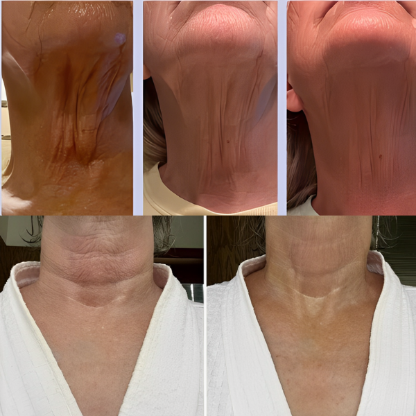 LiftNeck - Revitalize sua Pele | 1 UNIDADE