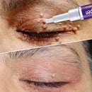 VerruDerma -  Removedor de Verrugas e Sinais Rápido e Eficiente